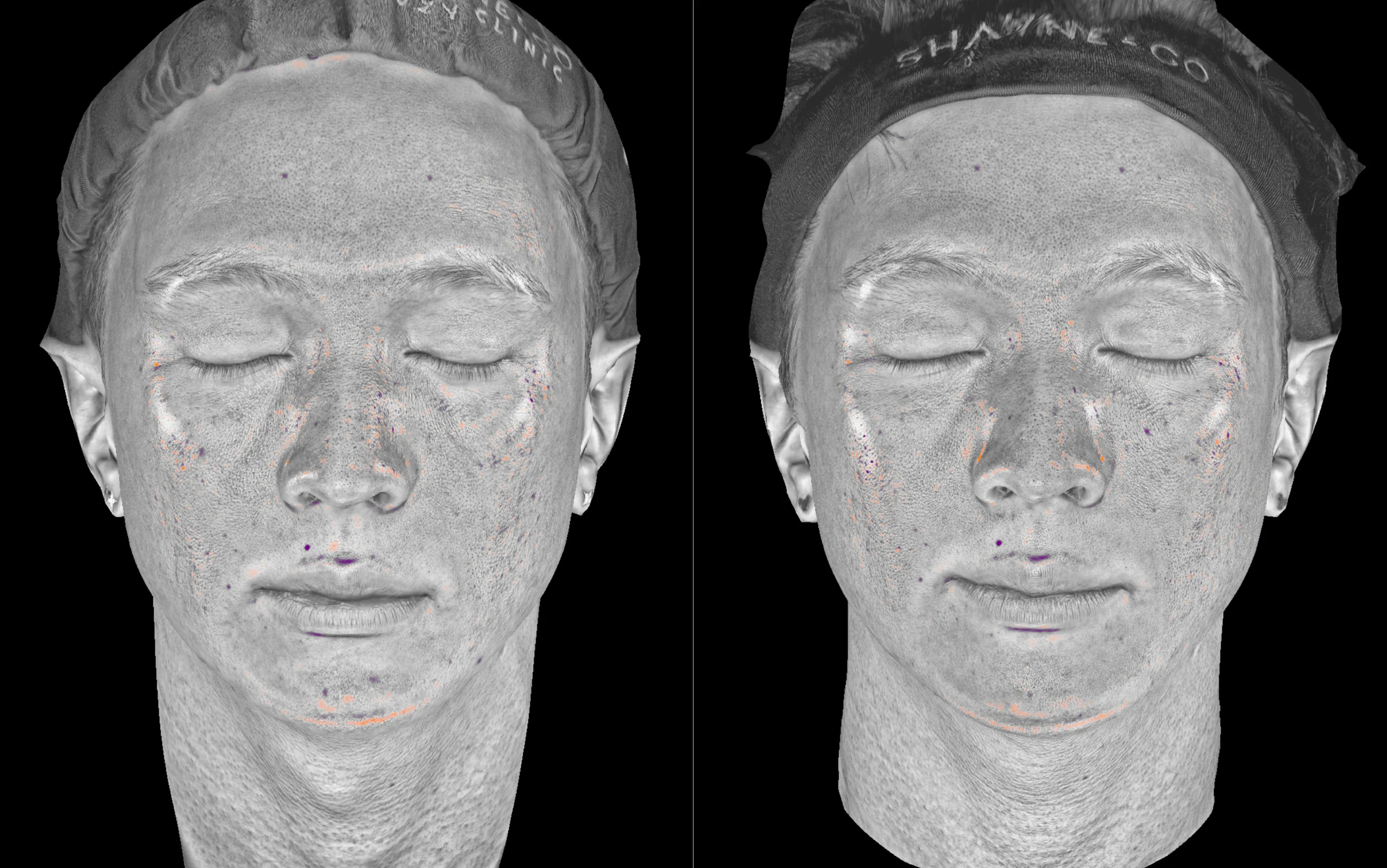 Skin Insight 360 mapping 4