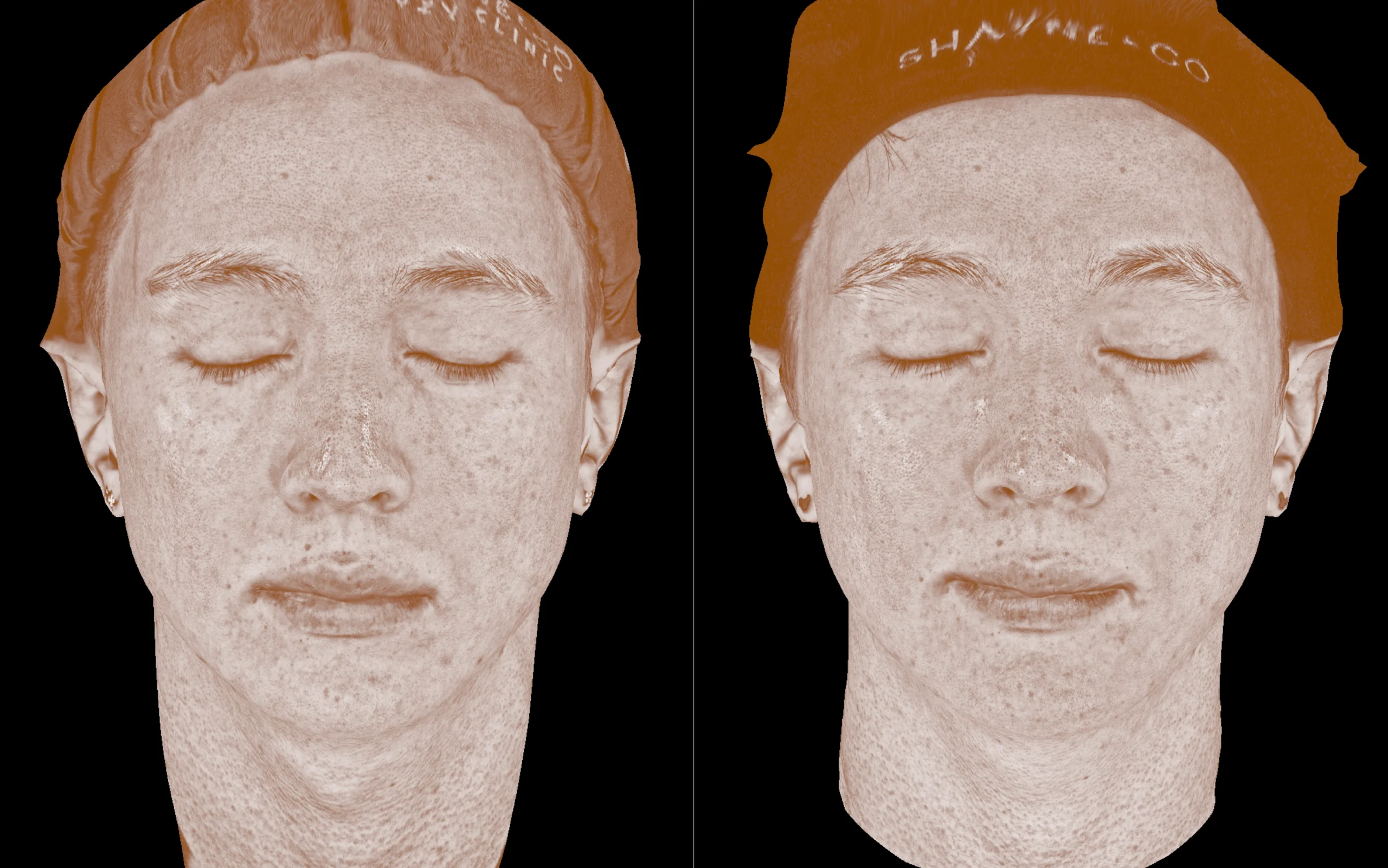 Skin Insight 360 mapping 1