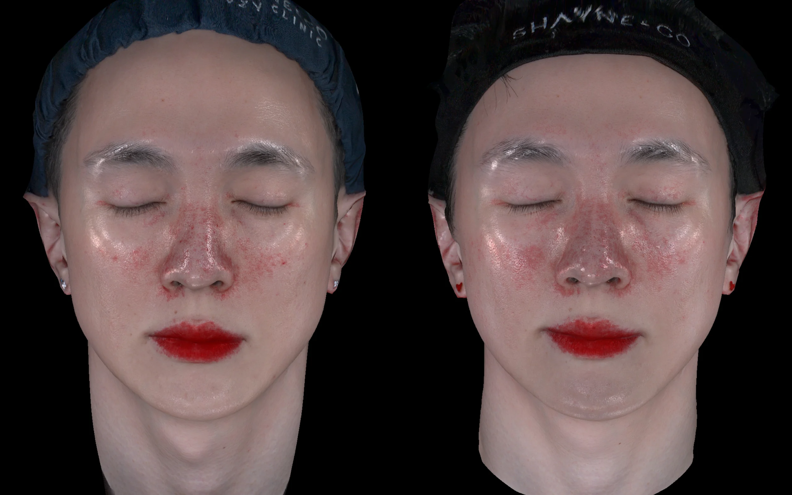 Skin Insight 360 mapping 2
