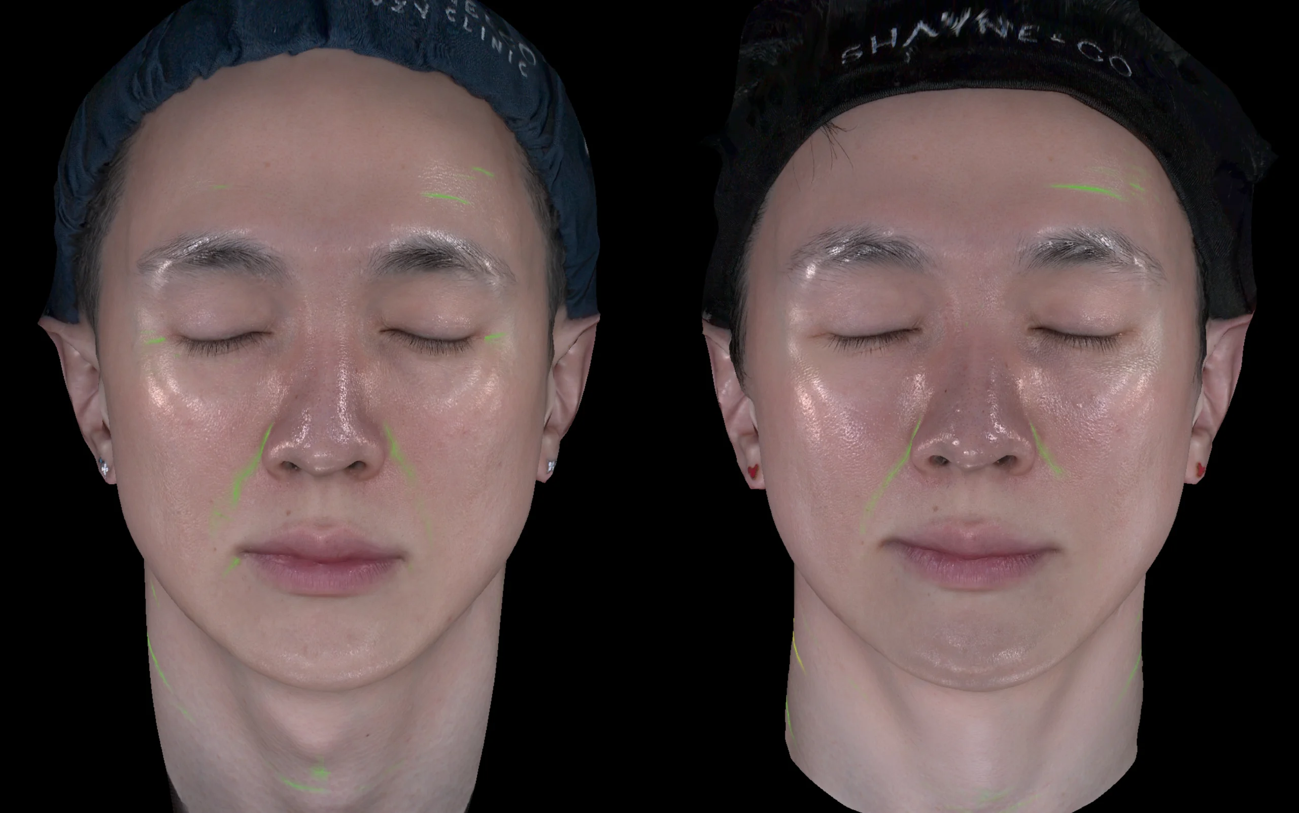 Skin Insight 360 mapping 5